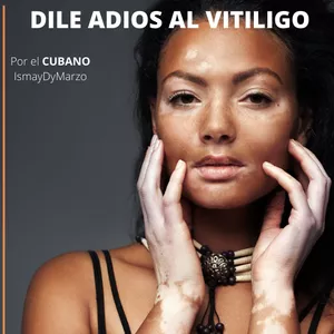 Derrotando Al Vitiligo
